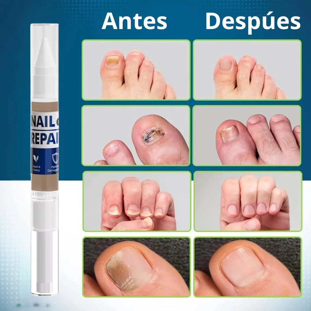 MyCurePro® · Elimina hongos en pies y manos · 7 días