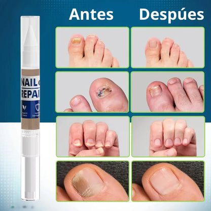 MyCurePro® · Elimina hongos en pies y manos · 7 días