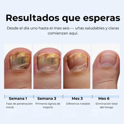 LAPIZ HONGOS – Tratamiento localizado, acción antifúngica y recuperación visible en uñas y piel