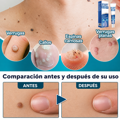 CREMA PARA ELIMINAR VERRUGAS – Cuidado localizado para imperfecciones