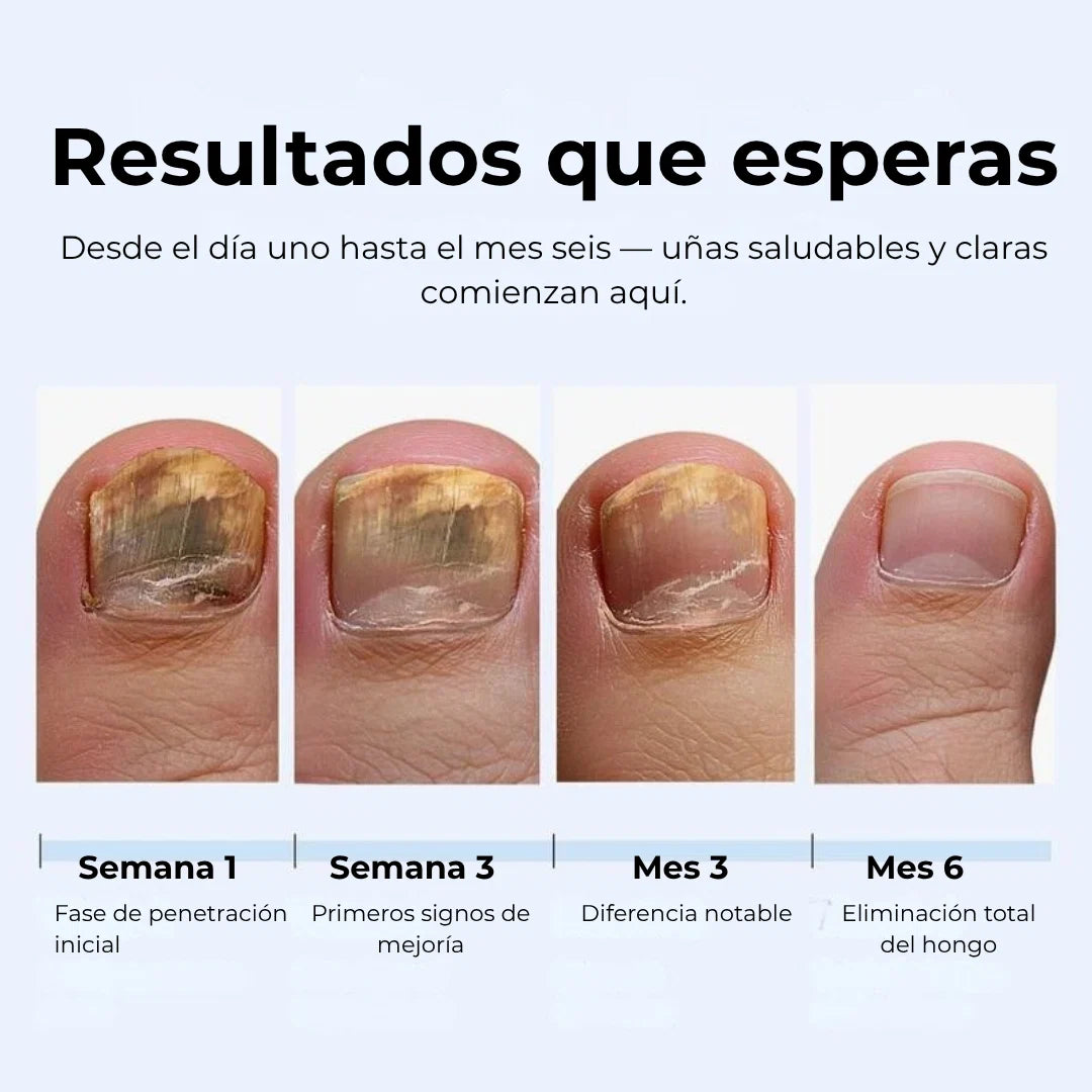 MyCurePro® · Elimina hongos en pies y manos · 7 días
