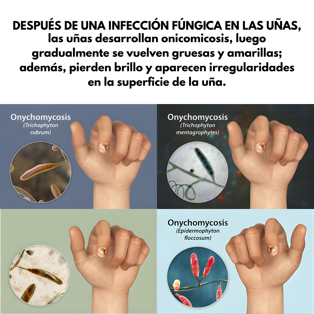 7 DAYS NAIL FUNGUS TREATMENT — Elimina el hongo, regenera y fortalece tus uñas desde la raíz