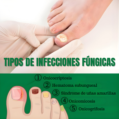 7 DAYS NAIL FUNGUS TREATMENT — Elimina el hongo, regenera y fortalece tus uñas desde la raíz