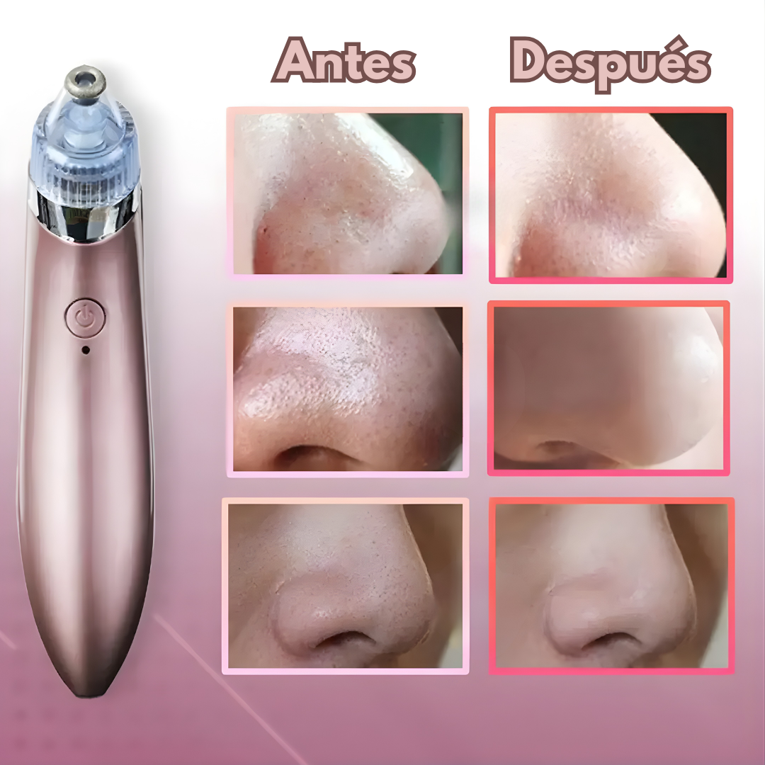 LIMPIADOR FACIAL POR SUCCIÓN – Limpieza profunda, poros visibles más limpios y piel renovada desde casa