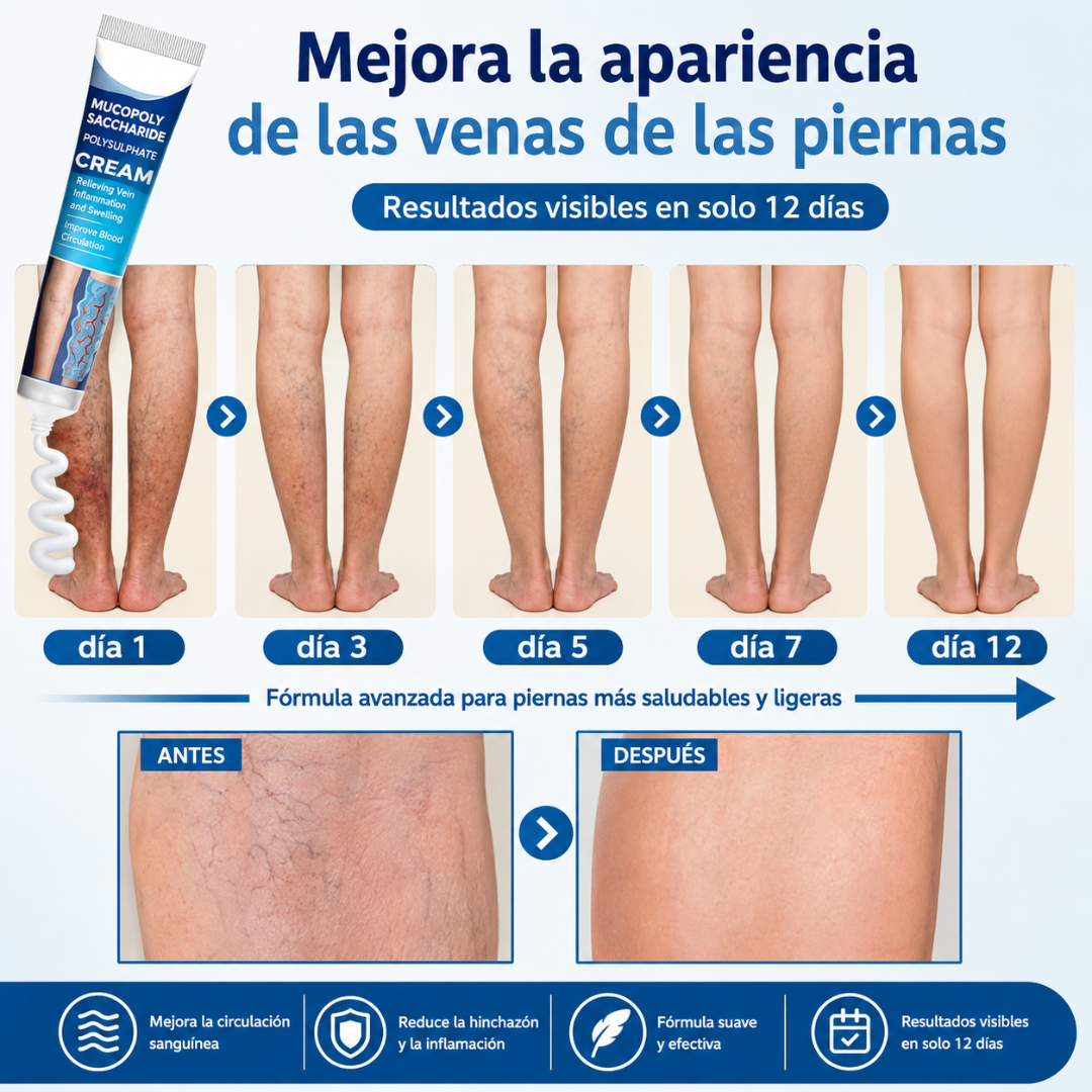CREMA PARA ALIVIAR LAS VARICES – Alivio para piernas cansadas