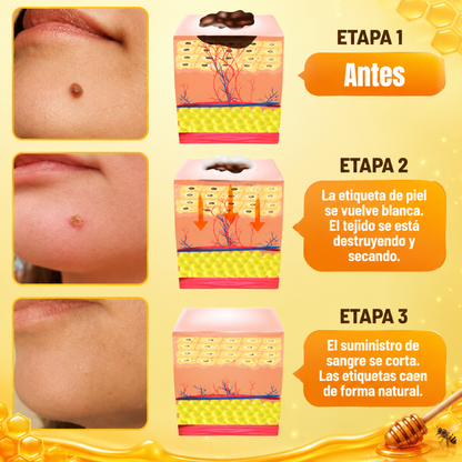 TAG RECEDE VENENO DE ABEJAS – Cuidado localizado para verrugas