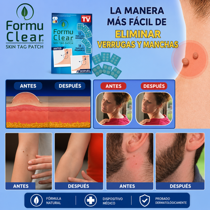 PARCHES PARA QUITAR VERRUGAS (108) — Discreción, constancia y piel más limpia